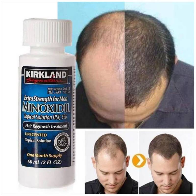 Tonico Minoxidil Kirkland Para Crecimiento de Barba Y Cabello Usp